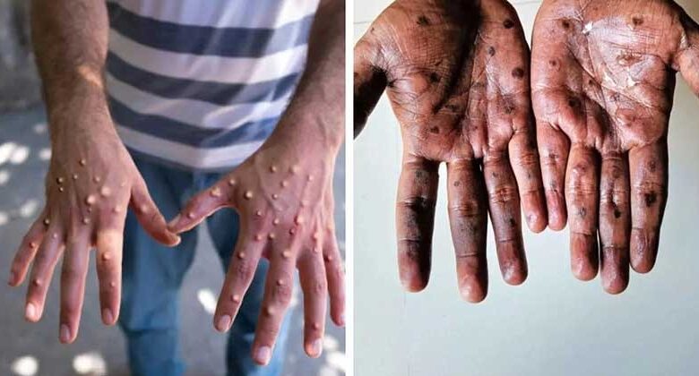 m pox
